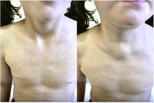 Frontal view. Left: no evidence of a suprasternal mass with the patient at rest. Right: appearance of a suprasternal mass with performance of the Valsalva manoeuvre, which did not cause pain, aphonia, dysphagia or dyspnoea.