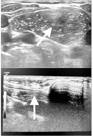 Ultrasound image of the suprasternal region during the Valsalva manoeuvre. Top: axial plane. Bottom: sagittal plane. Both show thymic tissue with normal sonographic characteristics with suprasternal herniation (white arrows).