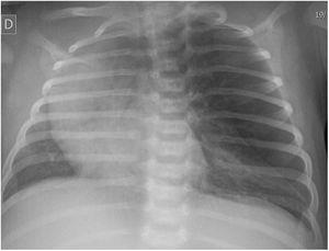 Hyperinflated and hyperlucent left hemithorax with contralateral mediastinal shift.