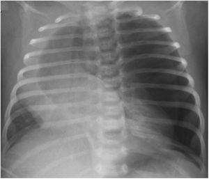 Iatrogenic pneumothorax in left lung associated with the pre-existing congenital lobar emphysema with marked contralateral mediastinal shift.