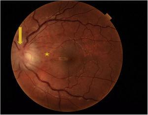 Oedema of the optic disc and peripapillary retina in the left eye (arrow); dot-and-blot haemorrhage around the papillomacular bundle (asterisk); vascular engorgement.