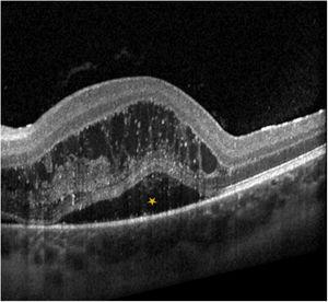 Left-eye macular optic coherence tomography scan evincing macular oedema (asterisk).
