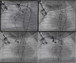 (A) Selective catheterization with multipurpose catheter from the left subclavian artery. (B) Coronary guidewire advanced over the microcatheter to the medial bronchial artery. (C and D) Release of coils, achieving effective embolization of the vessel.