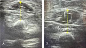 Ultrasound assessment of the biceps brachii/brachialis and quadriceps femoris muscle thickness. Transverse section obtained with a linear probe. A: Biceps brachii/brachialis: BB, biceps brachii; B, brachialis. B: Quadriceps femoris: RF, rectus femoris; VI, vastus intermedius.