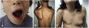 Different sequelae following radical surgical resection of lymphatic malformations. Full peripheral facial nerve palsy following surgery for cervicofacial LM (A), winged scapula resulting from spinal nerve injury (B) and right breast hypoplasia with significant loss of soft tissue (C).