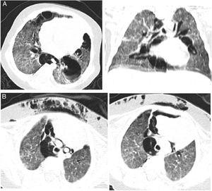 (A) Computed tomography scan in axial and coronal planes showed bilateral diffuse interstitial infiltration in the lungs and subpleural thin-walled cysts. (B) Pneumomediastinum and subcutaneous.