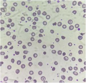 Peripheral blood smear showing numerous pyknocytes and contracted hyperdense burr cells (original magnification ×500).