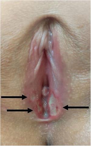 Physical examination at admission: 3 vulvar ulcers, the most prominent measuring 12mm, with a purplish-red border and a deep, necrotic base in the left inner fold of the vulva, and the 2 smaller ulcers on the right (“kissing” lesions).