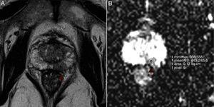 Example of ROI placement. Left peripheral prostate cancer in a 67-year-old man (PSA 9.5ng/mL; Gleason Score of 8). (A) Axial T2-weighted MR image shows a left peripheral hypointense tumor (arrow). (B) ADC map reveals left suspicious hyposignal lesion and ROI placement (arrow).