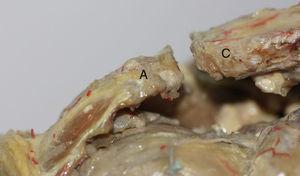 Visión anteroposterior de la articulación acromioclavicular. Tras resecar cápsula y ligamentos vemos la orientación de la carilla articular del acromion hacia anterior, superior y medial y la carilla articular de la clavícula que se orienta hacia posterior, inferior y lateral. A: acromion y C: clavícula.