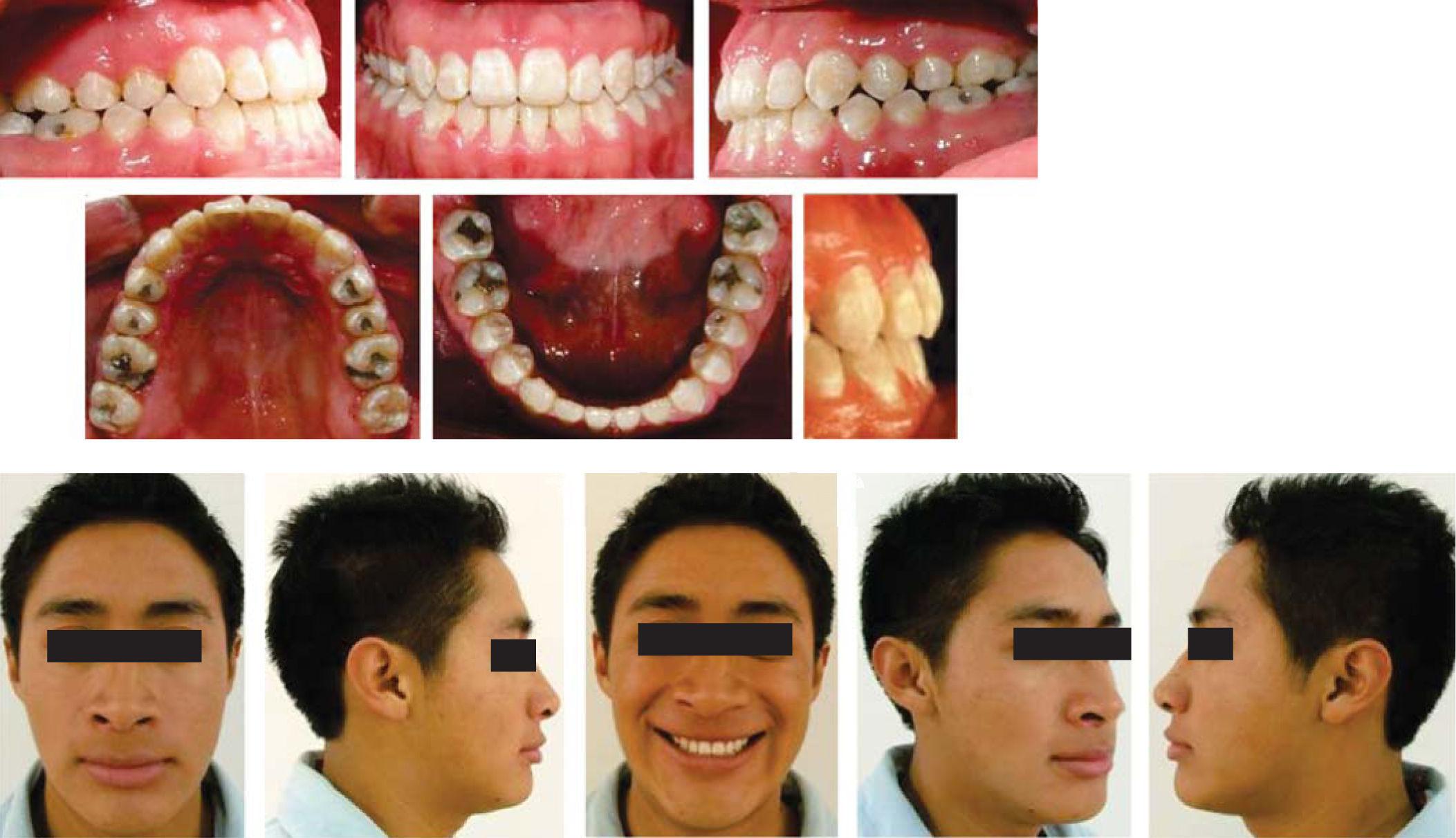 Ortodoncia y cirugía maxilofacial: un equipo multidisciplinario.  Presentación de un caso clínico | Revista Mexicana de Ortodoncia
