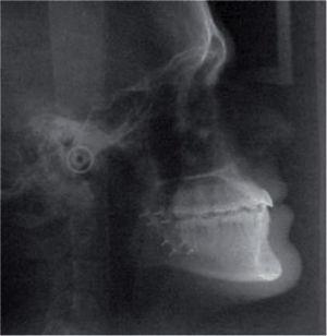 Radiografía lateral de cráneo final.