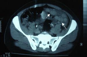 Pelvic computed tomography. Presence of multiple nodules of variable shape and size (arrows).
