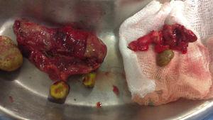 Gallbladder with lithiasis and appendix with fecalith.