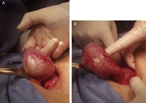 (A and B) Presence of the caecal appendix inside the hernia sac.