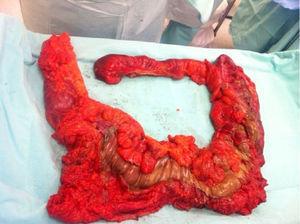 Product of colonic resection, with extensive necrosis of the caecum, ascending and transverse colon.