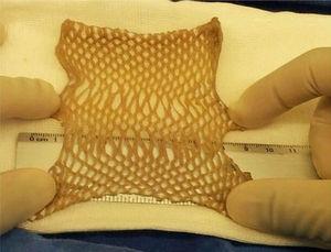 Meshed human skin allograft recovered for transplant uses.