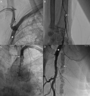(A) Evidence of high angulation of the right subclavian artery after the axillobifemoral bypass outlet (asterix). (B) Stenosis of the left radial artery (arrow). (C) Sub-occlusion at the level of the proximal third of the left subclavian artery (arrow). (D) High angulation at the level of the superficial femoral artery (arrow) with axillofemoral bypass (arrow) connected to the deep femoral artery.