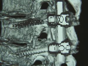 Sagittal plane tomography showing well-placed screws and rods.