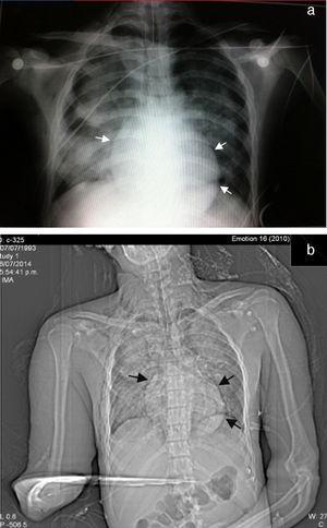 (a and b) Chest X-ray. Wide areas of consolidation of the lung parenchyma can be observed, a faint radiolucent line can be seen corresponding to pneumopericardium.