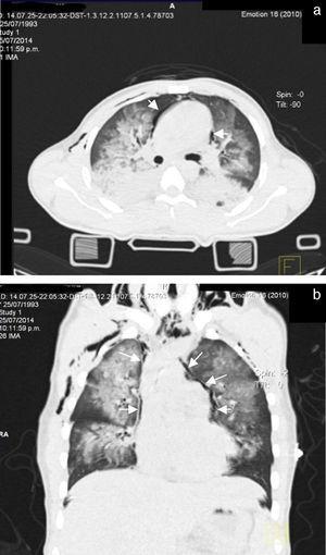 (a and b) Plain axial plane CT of chest with coronal reconstruction. Wide areas of consolidation and ground-glass can be identified related to lung contusions. On a cardiomediastinal level, a radiolucent pericardial halo is apparent associated with pneumomediastinum.