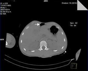 Plain abdominal tomography, axial plane. Under the diaphragmatic cupola and adjacent to the anterior wall free intra-abdominal air is apparent with no evidence of hollow viscera injury.