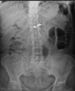 Case 2. AP abdominal X-ray. Image compatible with dental bridge. Day 1 after ingestion.