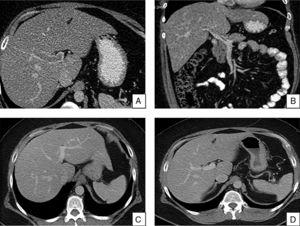 (A and B) Abdominal CT with contrast showing filling defect in the main portal vein and its branches, predominantly in the left portal branch, in the portal-splenic-mesenteric axis, compatible with partial thrombosis of portal vein and main branches. (C and D) Repeat abdominal CT at six months showing complete recanalisation of the main portal vein, branches and the portal-splenic-mesenteric axis.