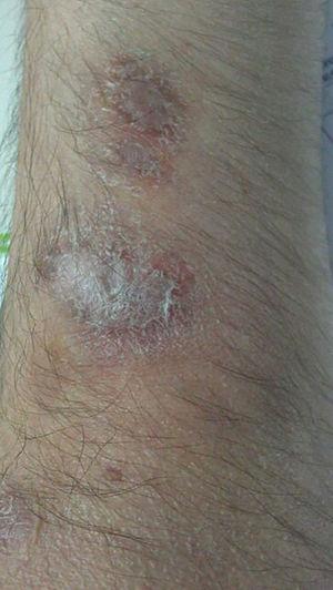 Residual scar after antibiotic treatment.