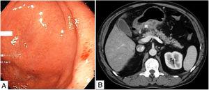 (A) Slight subepithelial bulge of the gastric antrum with erythematous mucosa. (B) Abdominal CT showing diffuse thickening of the posterior gastric wall with necrotic areas (*).