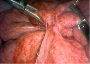 Surgical view during laparotomy. The early formation of an adhesion between the omentum and the small intestine is observed.