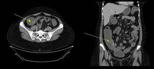 Image of endometriosis mimicking carcinoid lesion in the caecum. Cross-sectional and coronal section of the double-contrast CT scan where a lobular lesion was identified in the caecum adjacent to the ileocaecal valve of approximately 27×21×20mm, suggestive of carcinoid tumour lesion. The green arrow is pointing to the lesion.