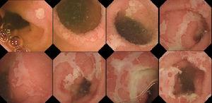 Endoscopic capsule images showing geographic ulcers of different sizes in various sections of the jejunum (Courtesy of Dr. Jose Manuel Blas).
