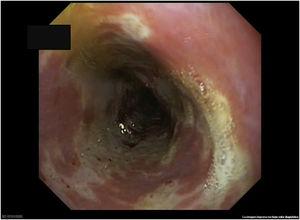 Image of the distal segment of the oesophagus with severe oesophagitis covering the entire circumference, in addition to friable mucosa, whitish exudate and ulcerations.