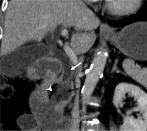 Contrast enhanced coronal CT, in which a duodenal diverticulum (black arrow) with air fluid level is observed (arrow head). Secondary dilatation of the common bile duct (white arrow).