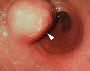 Gastro-duodenal endoscopy demonstrates the presence a round, well defined, protruding lesion with an overlying normal mucosa (arrowhead) at the level of the gastric antrum.