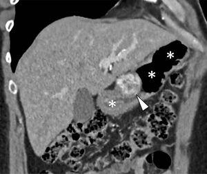 Contrast-enhanced multi-detector computed tomography coronal MPR reconstruction that shows, at the gastric (*) antrum level, the presence of a solitary intraluminal subepithelial mass, well defined (arrowhead), with high vascular enhancement and 4-cm in diameter.