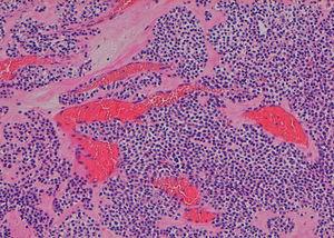 Histopathological evaluation that shows hyperplastic smooth muscle fibers around dilated thin-walled vascular network (magnification 100×).
