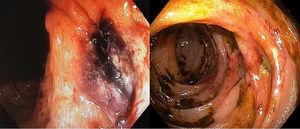 Impairment due to ischaemic colitis: on the left, segmental mucosal impairment with an ulcerated lesion; on the right, colonoscopy after two weeks showing an ulcer with a fibrinated base.