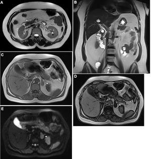 Axial (A) and coronal (B) T2 MRI shows a solid mass protruding inside the second duodenal portion at the location of the ampulla of Vater (arrowhead). This image is compatible with an ampullary tumour. MRI (C-D-E). A left adrenal lesion (arrowhead) is observed, showing signal drop between in-phase (C) and out-of-phase (D) images weighted in T1. This absence of signal indicates the presence of intracellular fat, considered diagnostic of adrenal adenoma. No restricted diffusion was demonstrated (E).