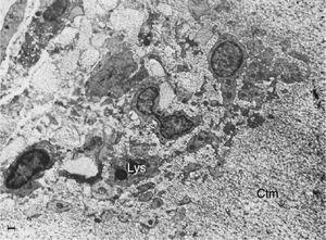 Electron microscope image showing fibroblasts with immersed lysosomes (Lys) and multiple cytoplasmic extensions invading the cartilage matrix (Ctm).10