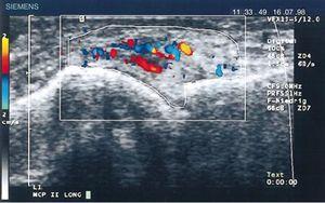 Longitudinal ultrasound of the metacarpophalangeal joint showing the first Doppler images with increased pannus vascularization in a patient with RA.70