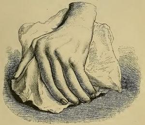 Illustration from Garrod's book depicting a deformed hand with ulnar deviation resulting from rheumatoid arthritis.1,2