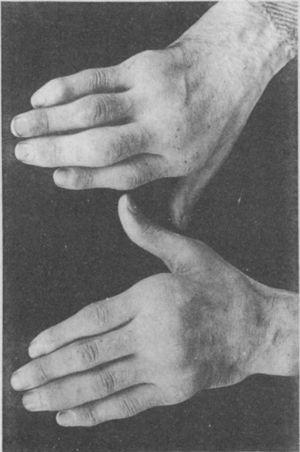 Photograph of the hands of a 35-year old patient with a history of gonococcal urethritis, who years later progressively developed polyarthritis of the small and large joints. Classified as proliferative arthritis.5,6