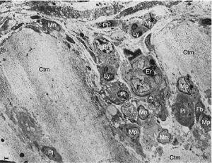 Electron microscope images of pannus. Illustration of a vessel invasion (En: endothelium; Er: erythrocyte) at the pannus/cartilage interface (Ctm) by lymphocytes (Ly), plasma cells (Pl), monocytes (Mn), macrophages (Mp) and fibroblasts (Fb).10