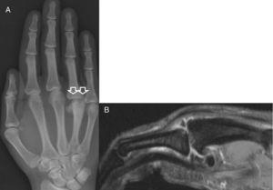 A) Radiografía dorso-palmar de la mano derecha mostrando colapso subcondral de la cabeza del metacarpiano y subluxación de la articulación MTCF. B) Resonancia magnética con área de osteonecrosis en la cabeza del cuarto metacarpiano.