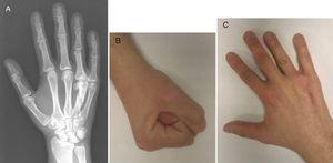 A) Radiografía dorso-palmar de la mano derecha tras 8 años desde el desbridamiento y curetaje del hueso necrótico en la cabeza del cuarto metacarpiano. B y C) Seguimiento final con flexión activa y extensión completas.