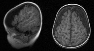 Sagittal and axial plane from brain MRI (T1-weighted sequence).