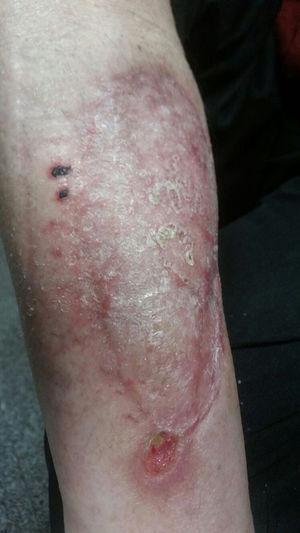 Appearance of the skin lesion 12 weeks after the surgical debridement and the start of antifungal treatment.