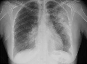 Chest X-ray on day four in hospital: progression of consolidation in the left lung and right perihilar region. Small bilateral pleural effusion.